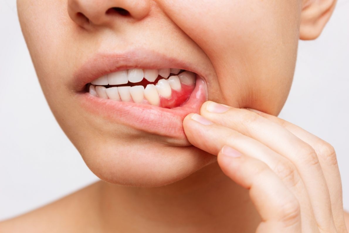 Denti che si muovono?
